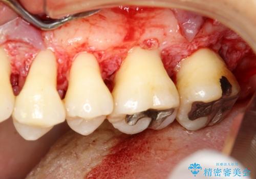 30代女性　前歯の前突感・ガタガタを改善　抜歯矯正