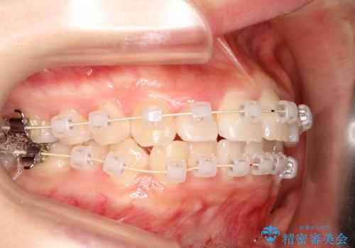 20代女性　非抜歯をオーソドックスなワイヤー矯正での治療中