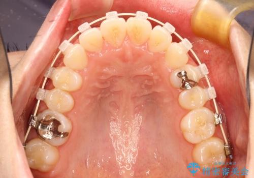20代女性　非抜歯をオーソドックスなワイヤー矯正での治療中