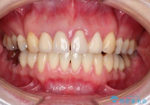 総合歯科診療　矯正希望で通院したら前歯がクラウンになっていた方の再治療の治療中