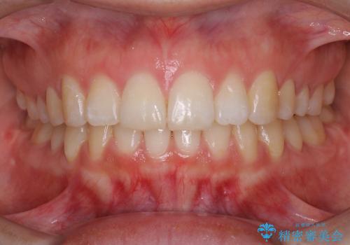 20代女性　インビザラインによる出っ歯の矯正の治療後