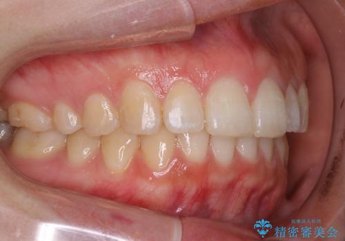 20代女性　インビザラインによる出っ歯の矯正の症例 治療後