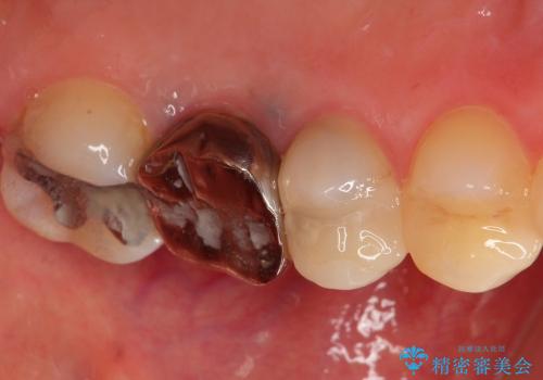 20代女性　骨レベルまで深い虫歯を保存するにはの症例 治療前