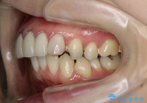 総合歯科診療　矯正希望で通院したら前歯がクラウンになっていた方の再治療