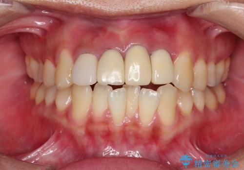 事故で抜けかけた歯　歯が溶けてしまった方のブリッジ治療の症例 治療前