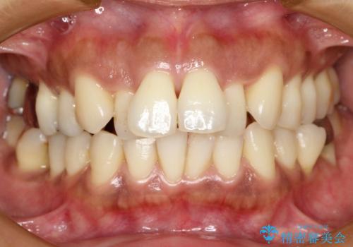 30代女性　前歯の前突感・ガタガタを改善　抜歯矯正の治療前