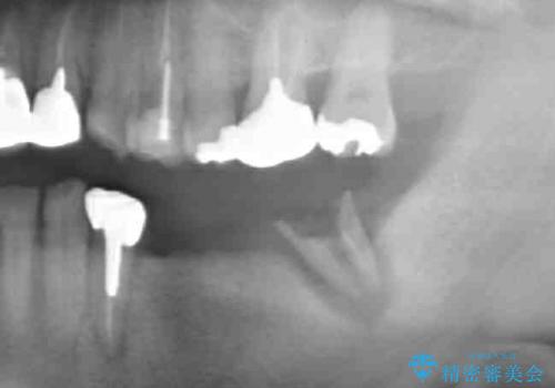 [咬合性外傷] インプラントで歯を残す治療の治療前