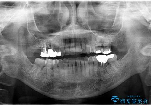 30代女性　前歯の前突感・ガタガタを改善　抜歯矯正の治療後