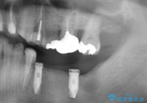 [咬合性外傷] インプラントで歯を残す治療の治療中