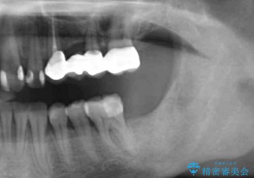 歯軸を改善したオールセラミックブリッジ治療の治療後