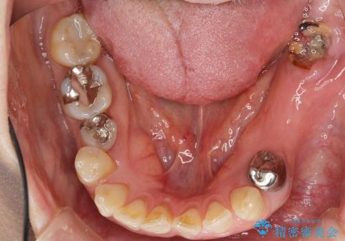 [咬合性外傷] インプラントで歯を残す治療の治療前