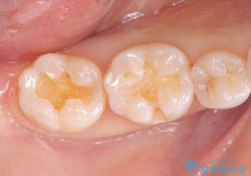 [セラミックインレー]  銀歯の下の虫歯再発 審美修復治療の治療中
