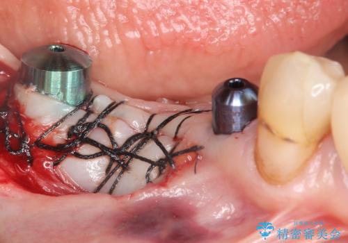 [遊離歯肉移植] インプラント周囲に強い歯ぐきを移植の治療中