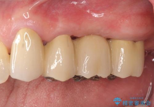 [歯周病治療③] メタルボンドブリッジ補綴で咬合機能の回復の症例 治療後