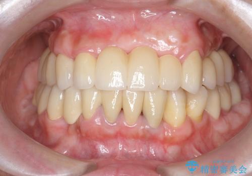 [顎堤増大]  歯肉移植を行い審美性を回復した前歯ブリッジ治療の治療後