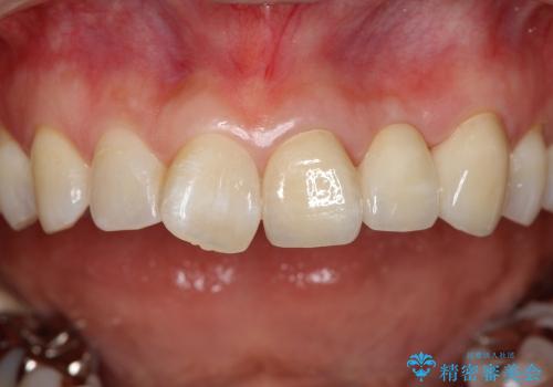前歯がグラグラで残せない　上顎前歯ブリッジ治療の症例 治療後