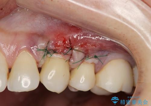 [知覚過敏]  歯ぐきが下がってしみる歯を歯肉移植で改善の治療中