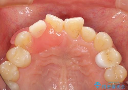 [前歯の審美・機能回復]  前歯を1本失った場合 3つの治療方法の治療後