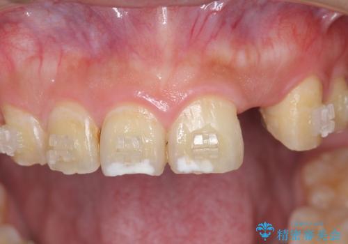[前歯の審美・機能回復]  前歯を1本失った場合 3つの治療方法の治療前