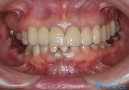 [前歯部ジルコニアブリッジ] 前歯の治療で見た目を美しくの治療後