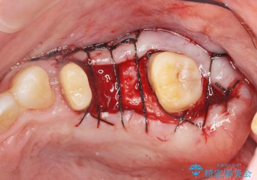 [歯周病治療②] 歯周ポケット除去手術の治療後