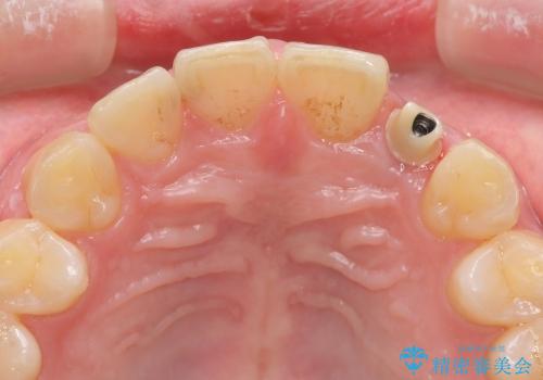 [前歯の審美・機能回復]  前歯を1本失った場合 3つの治療方法の治療中