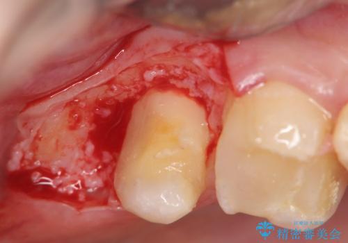 [歯周外科] 歯ぐきの状態を整えてからのセラミック治療