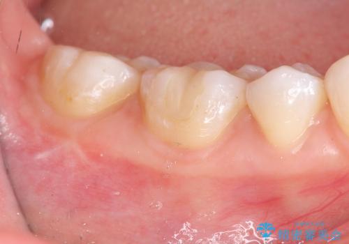 [セラミックインレー]  銀歯の下の虫歯再発 審美修復治療の治療後