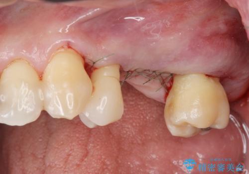 [歯周病治療①] 歯周病で溶けてしまった歯槽骨の再生手術　の症例 治療後
