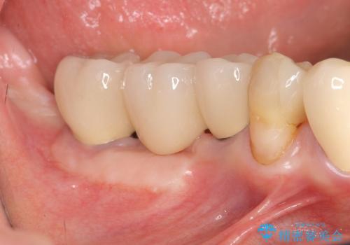 [遊離歯肉移植] インプラント周囲に強い歯ぐきを移植の治療後