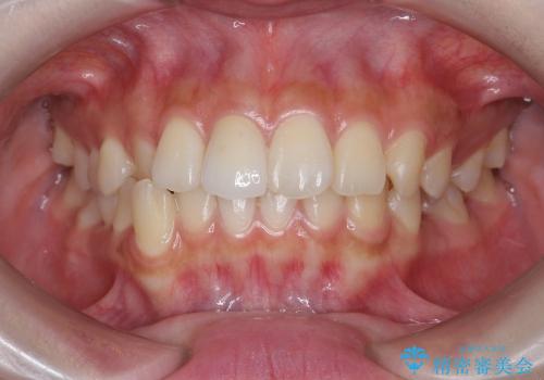 [オールセラミックジルコニアクラウン] 前歯の審美改善治療の治療後