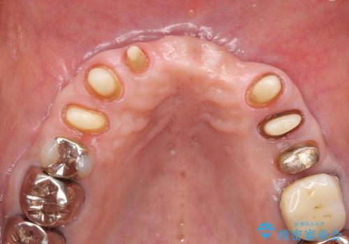 [前歯の審美・機能回復] 前歯を複数本失った場合 3つの治療方法の治療中