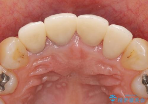 前歯の違和感・臭いを適合の良い精密なクラウンで改善の治療後