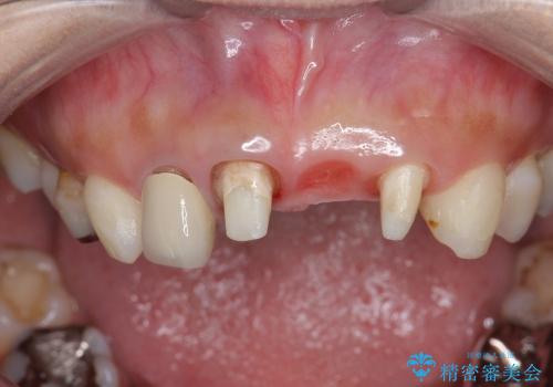 [前歯の審美・機能回復]  前歯を1本失った場合 3つの治療方法の治療中