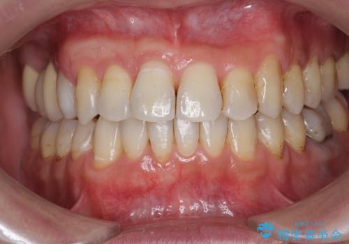 [歯ぐきの再生治療] 矯正治療前の歯ぐき移植の治療後
