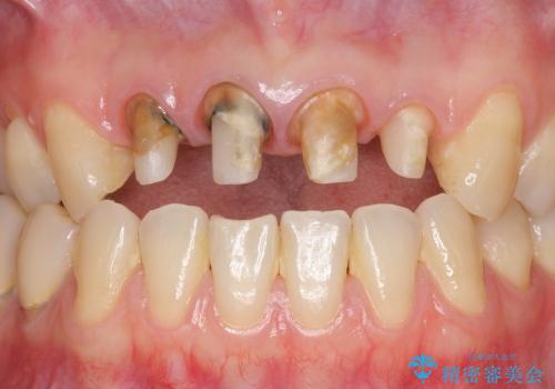 前歯の違和感・臭いを適合の良い精密なクラウンで改善の治療中