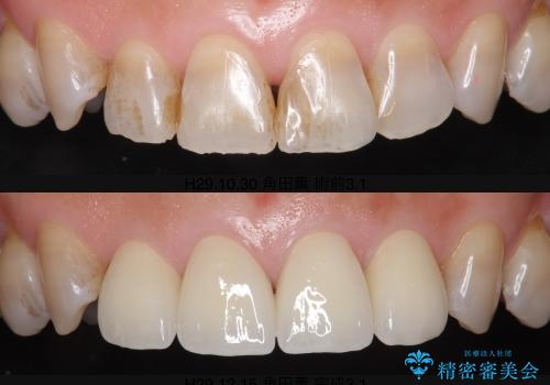 [前歯の審美治療] 変色した前歯をセラミック治療