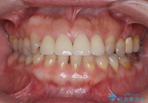 [前歯の審美治療] 変色した前歯をセラミック治療の治療後