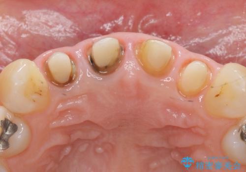前歯の違和感・臭いを適合の良い精密なクラウンで改善の治療中