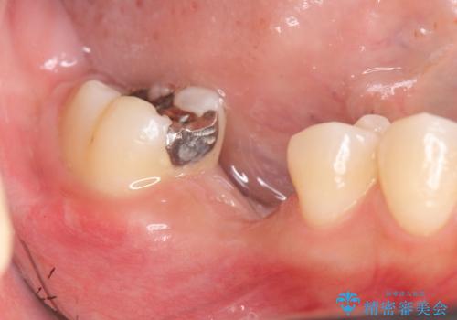 [根分岐部病変Ⅲ度]  悪化する奥歯の歯周病　インプラントを用いた治療の治療中