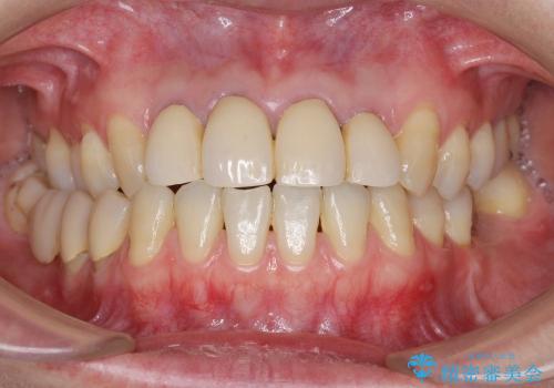 前歯の違和感・臭いを適合の良い精密なクラウンで改善の治療前