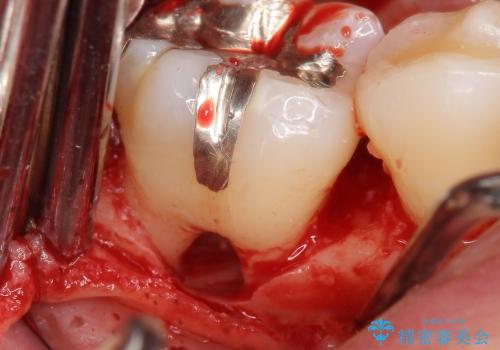[根分岐部病変Ⅲ度]  悪化する奥歯の歯周病　インプラントを用いた治療