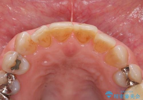 [前歯の審美治療] 変色した前歯をセラミック治療の治療前