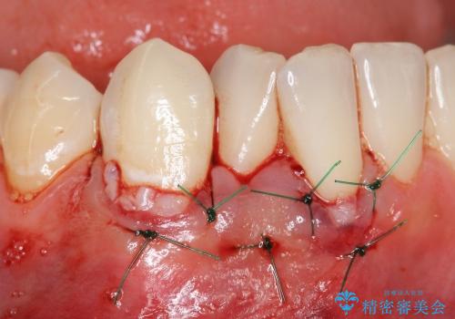 [歯ぐきの再生治療] 矯正治療前の歯ぐき移植の治療中
