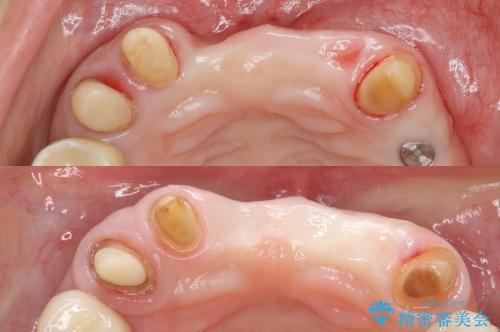 [顎堤増大]  歯肉移植を行い審美性を回復した前歯ブリッジ治療