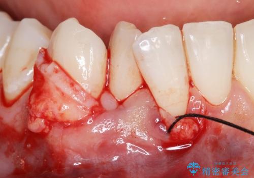 [歯ぐきの再生治療] 矯正治療前の歯ぐき移植