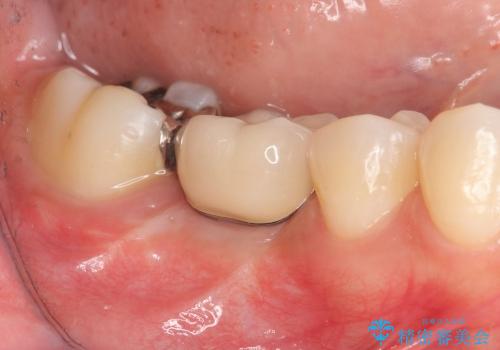 [根分岐部病変Ⅲ度]  悪化する奥歯の歯周病　インプラントを用いた治療の治療後
