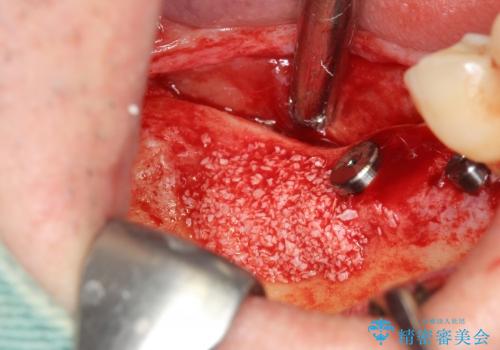 [重度歯周病] 骨造成を伴うインプラント咬合機能回復治療の治療中