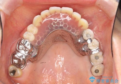 [前歯の審美・機能回復] 前歯を複数本失った場合 3つの治療方法の治療後
