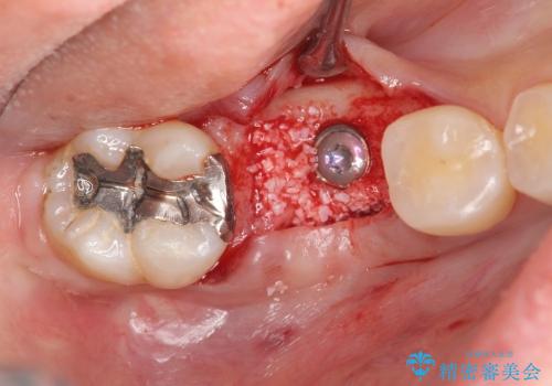 [根分岐部病変Ⅲ度]  悪化する奥歯の歯周病　インプラントを用いた治療の治療中